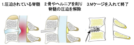 頚椎前方固定術1