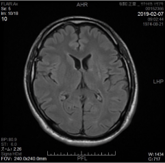 治療後 MRI