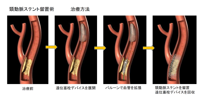 ステント留置術