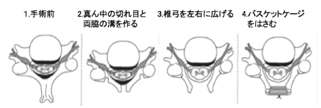 頚椎椎弓形成術1