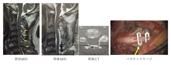 頚椎椎弓形成術2