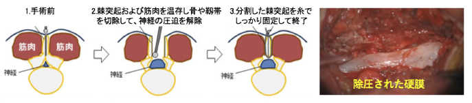 腰椎椎弓形成術1