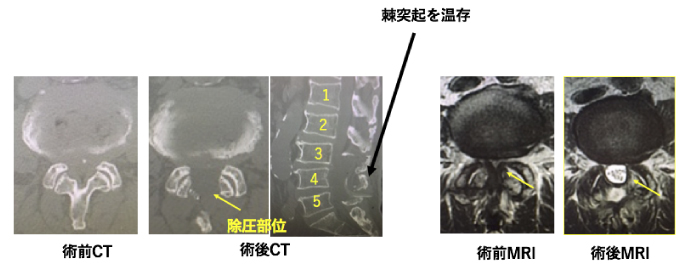 腰椎椎弓形成術2