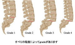 腰部脊柱管狭窄症