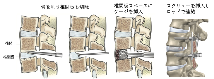 腰椎すべり症の手術1