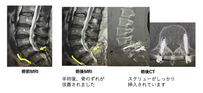 腰椎すべり症の手術2