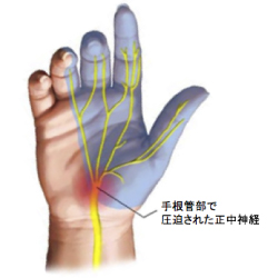 肘部管症候群