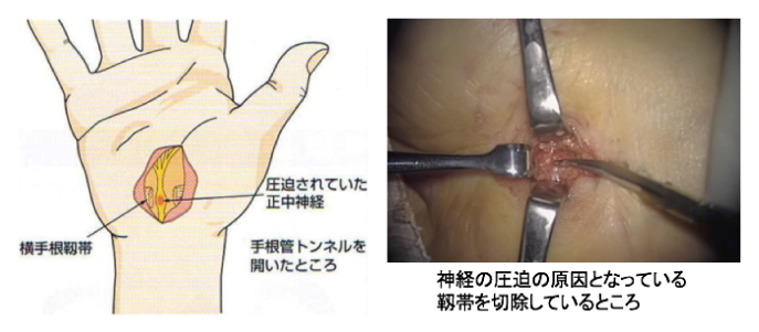手根管開放手術