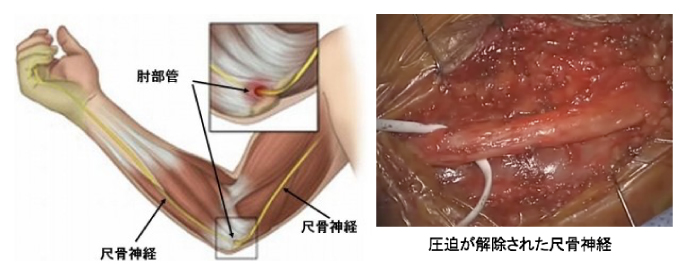 肘部管開放手術